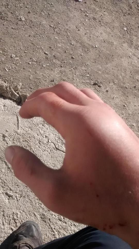 My broken right hand, so swollen that the skin raised above all of my knuckles