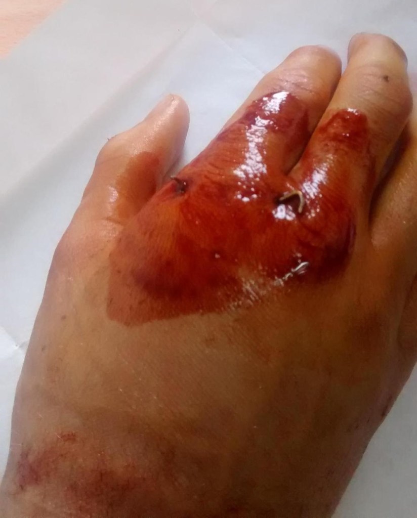 When my bandages were being replaced by Zolboo and Baljka, I was able to catch a glimpse of the metal pins awkwardly sticking out of my hand