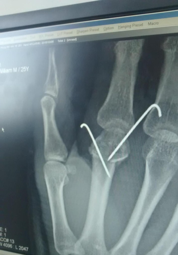 An x-ray of the same pins showing how far they were embedded into my hand