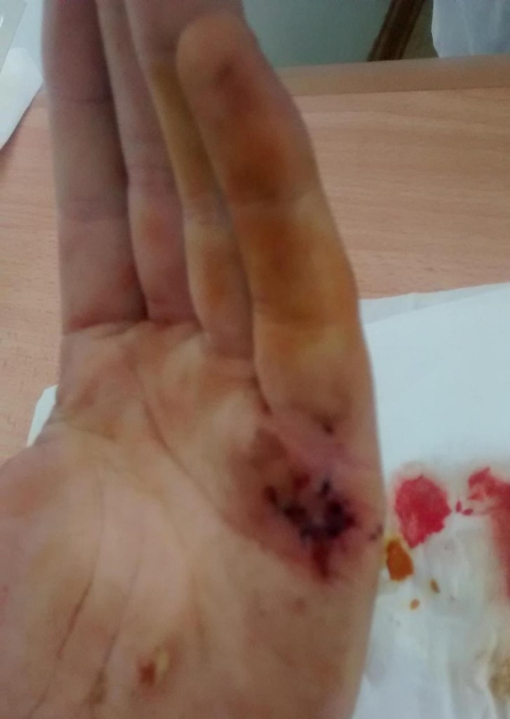 My infected left hand finally stitched up